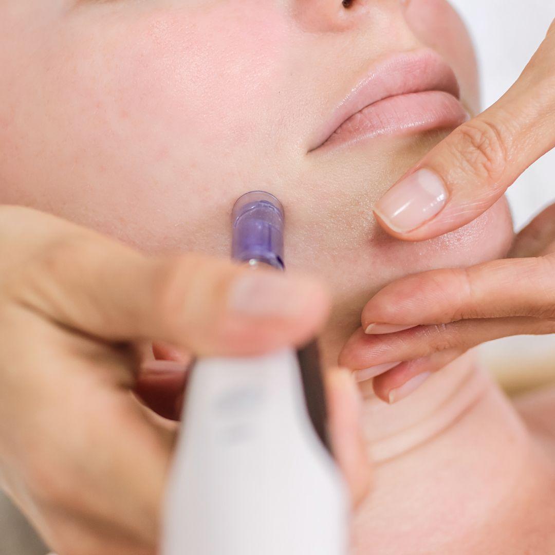 Terapia de Inducción de Colágeno