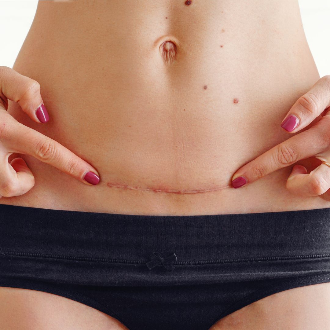 Cuidado de cicatrices